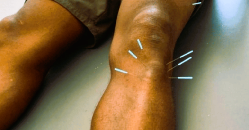 Risks Associated with Dry Needling