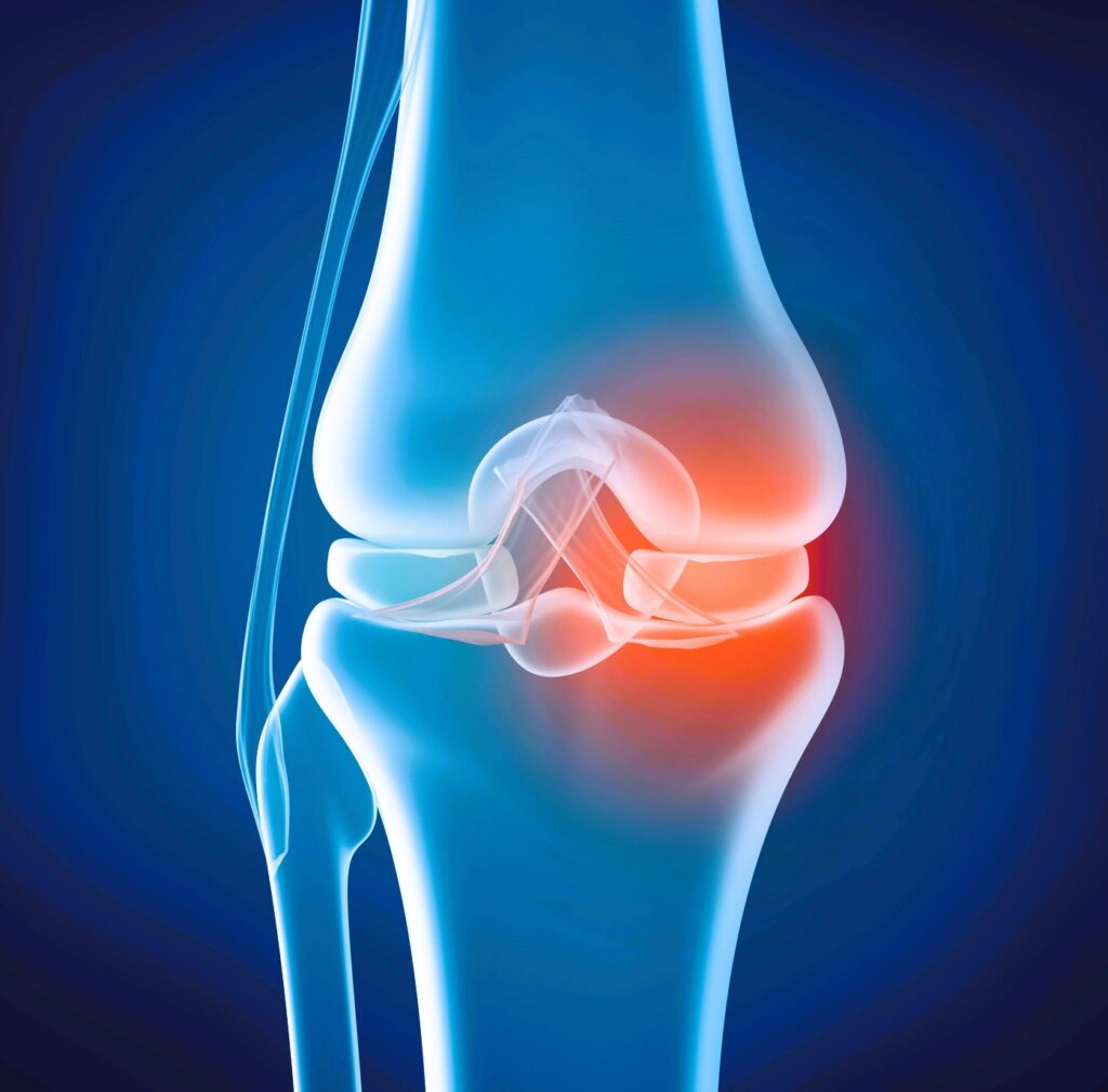 satisfaction with knee replacement 